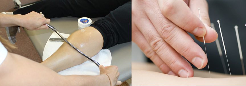 graston-dry-needling help for trigger point pain - Hampton Physical Therapy graston-dry-needling